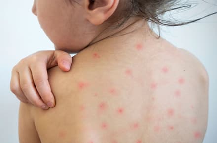 Vaccination